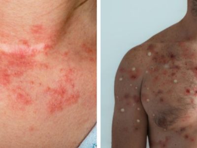 LAS VEGAS, NV - In a case of misplaced outrage a flight attendant revealed she actually does know the difference between Monkeypox and Eczema. She just doesn't like Eczema. Monkeypox is fine though.